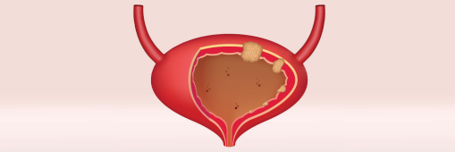 Nieuwe methode: kleine blaastumoren worden met laser behandeld